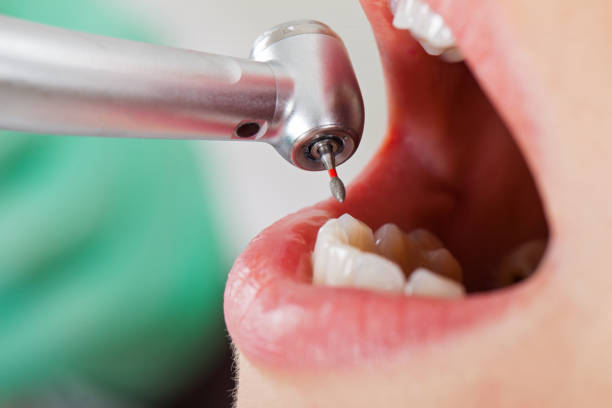 Best Emergency Dentist for Lost Fillings or Crowns in Manhattan, IL
